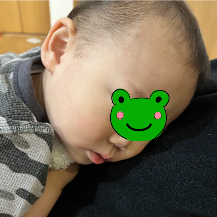 アデノウィルスに感染した１歳児