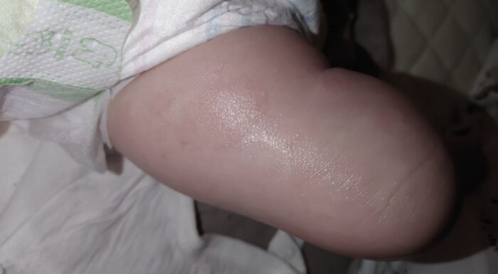 生後4ヶ月の赤ちゃんの肌荒れ